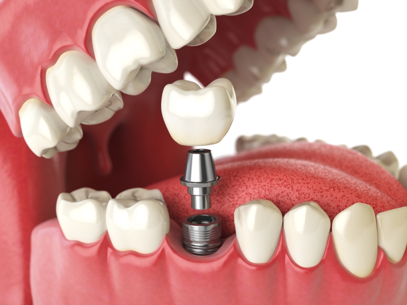 Factors You Should Consider To Choose The Right Type Of Dental Implant